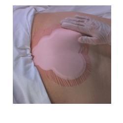 MEDICAZIONE IDROCELLULARE ADESIVA STERILE CONFORMATA PER LA REGIONE SACRALE ASSORBENTE IN SCHIUMA DI POLIURETANO ALLEVYN SACRUM 22,5X22,1CM 10PZ - Farmacia De Pasquale